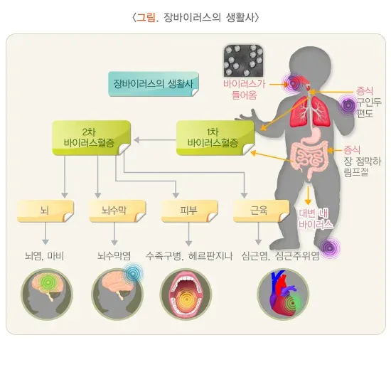 수족구병 경과 및 예후 설명 이미지 1