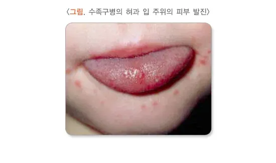 수족구병 증상 설명 이미지 1
