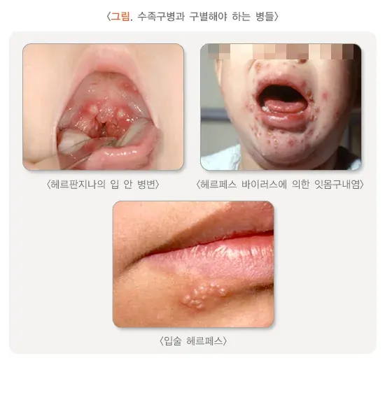 수족구병 연관 주제어 설명 이미지 1