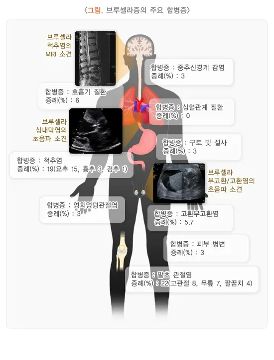 사람 브루셀라증 합병증 설명 이미지 1