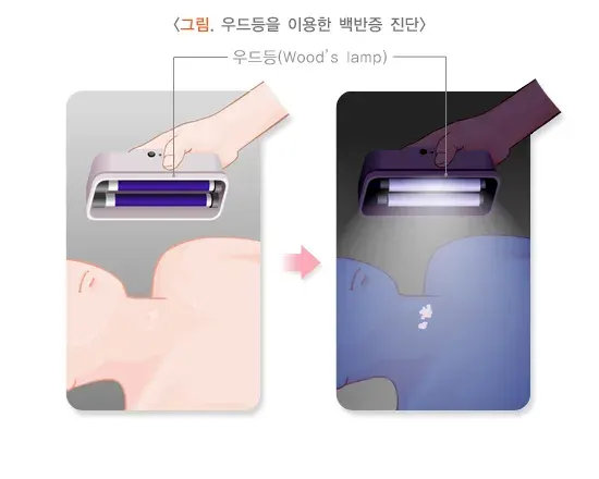 백반증 진단 및 검사 설명 이미지 1