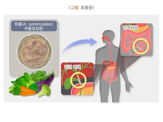 회충증 증상 설명 이미지 1