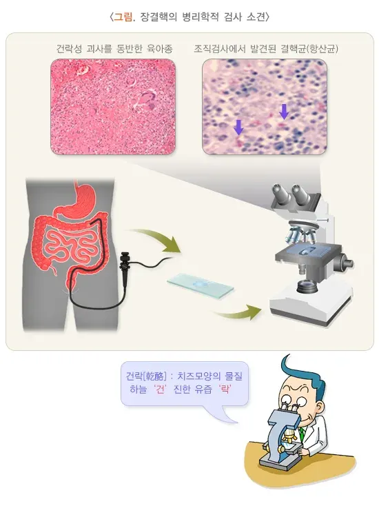 장결핵 진단 및 검사 설명 이미지 4
