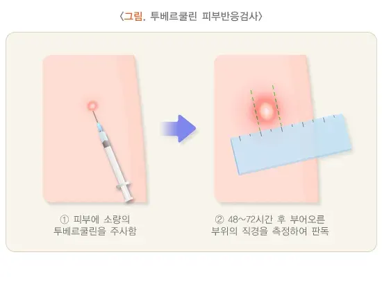 장결핵 진단 및 검사 설명 이미지 5