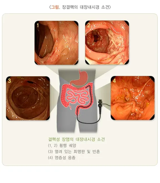 장결핵 진단 및 검사 설명 이미지 2