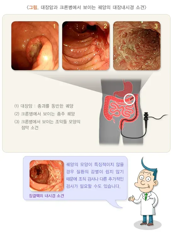 장결핵 진단 및 검사 설명 이미지 3