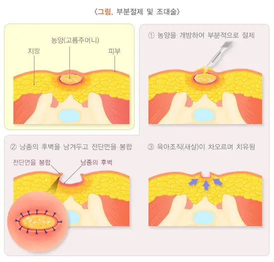 모소낭 치료 설명 이미지 3