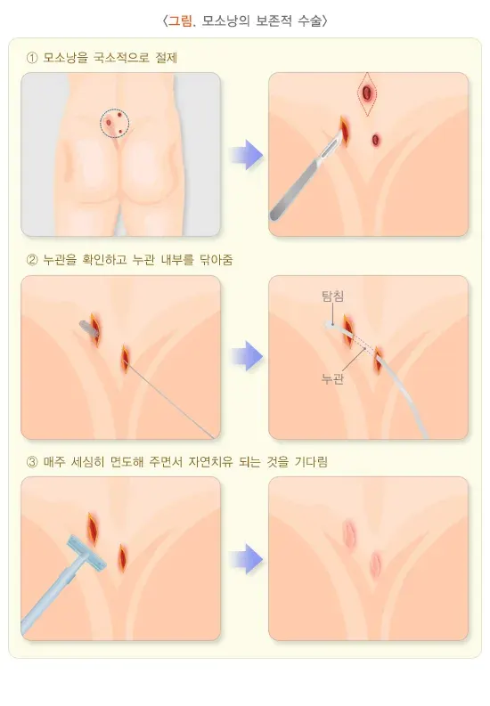 모소낭 치료 설명 이미지 1