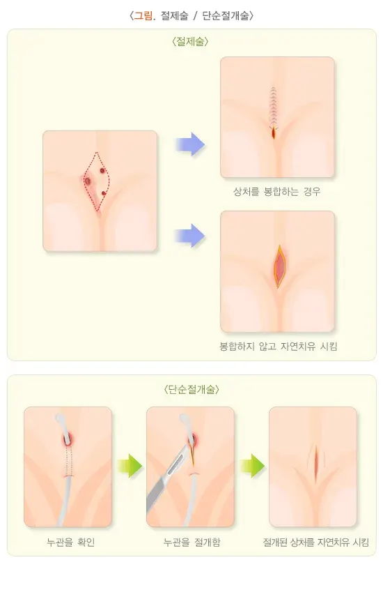 모소낭 치료 설명 이미지 2