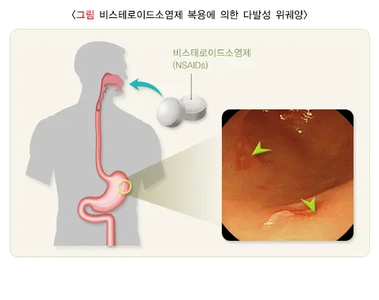 위십이지장 궤양 원인 설명 이미지 2