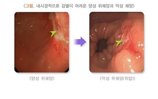 위십이지장 궤양 진단 및 검사 설명 이미지 2