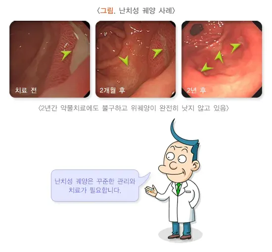 위십이지장 궤양 약물 치료 설명 이미지 1