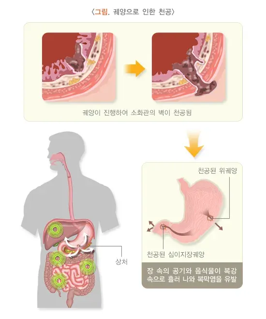 위십이지장 궤양 합병증 설명 이미지 2