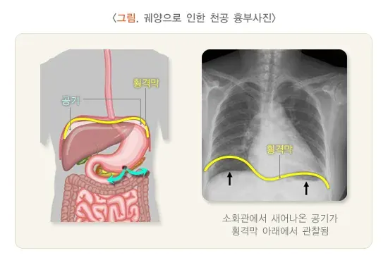 위십이지장 궤양 합병증 설명 이미지 3