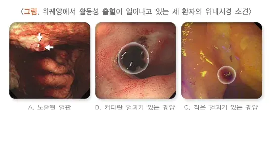 위십이지장 궤양 합병증 설명 이미지 1