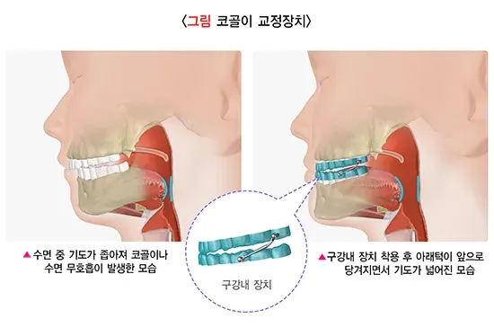 코골이 치료 설명 이미지 1