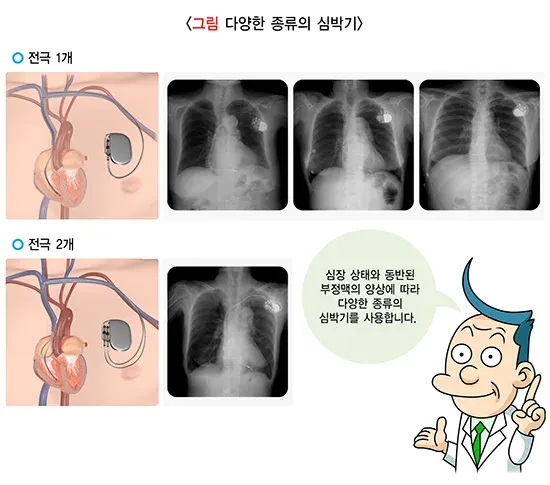 심장박동조율기 연관 주제어 설명 이미지 1