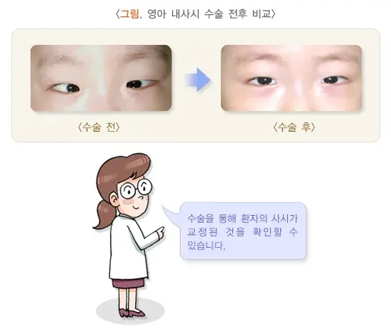 사시 종류 설명 이미지 3