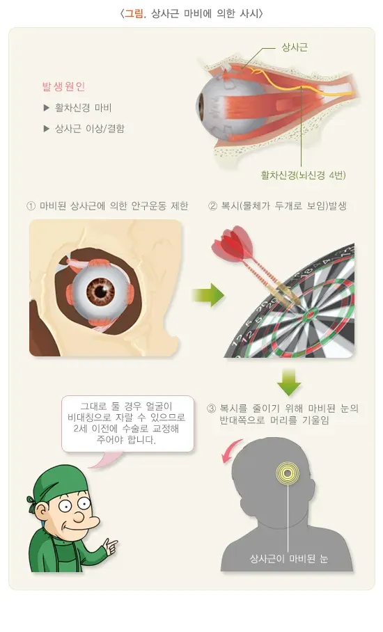 사시 종류 설명 이미지 5