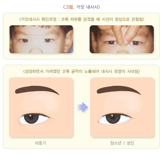 사시 종류 설명 이미지 2
