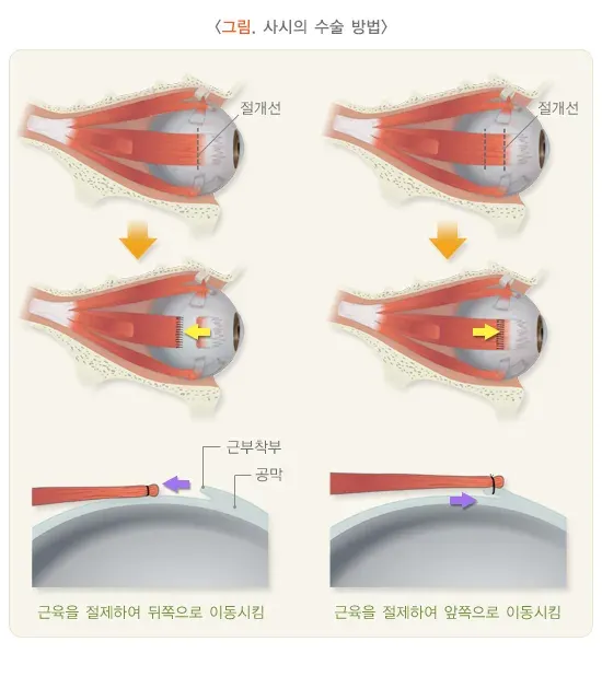 사시 치료 설명 이미지 2