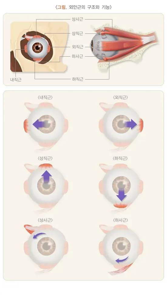 사시 치료 설명 이미지 1