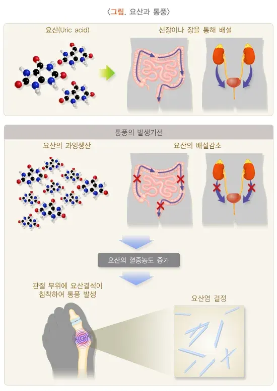 통풍 원인 설명 이미지 1