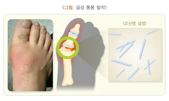 통풍 경과 및 예후 설명 이미지 1