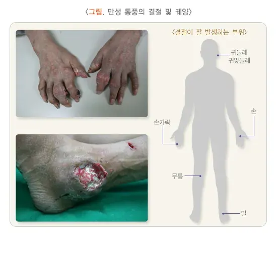 통풍 경과 및 예후 설명 이미지 2