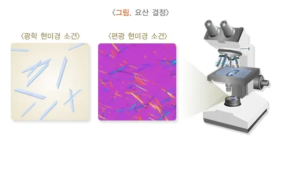 통풍 진단 및 검사 설명 이미지 1