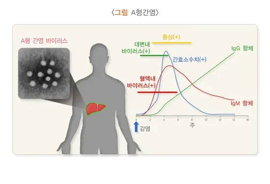 A형간염 진단 및 검사 설명 이미지 1