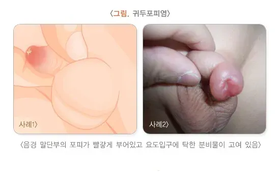 포경수술 치료의 적응증 설명 이미지 1