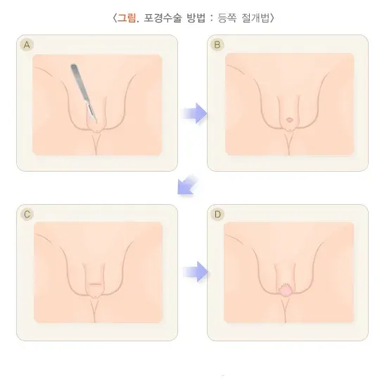 포경수술 치료 방법 설명 이미지 1