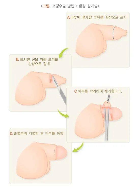 포경수술 치료 방법 설명 이미지 2