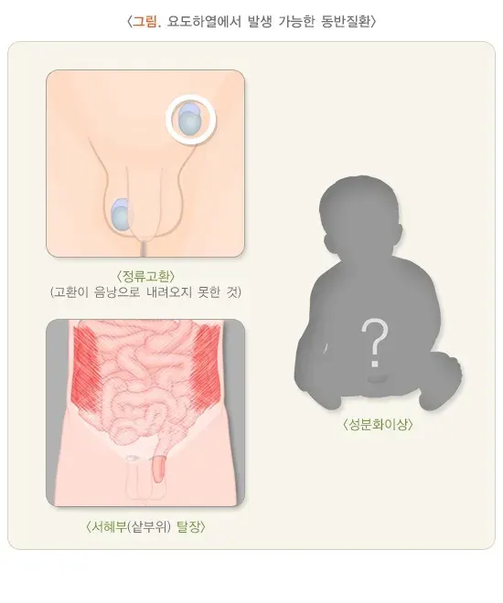 요도하열(소아) 증상 설명 이미지 1