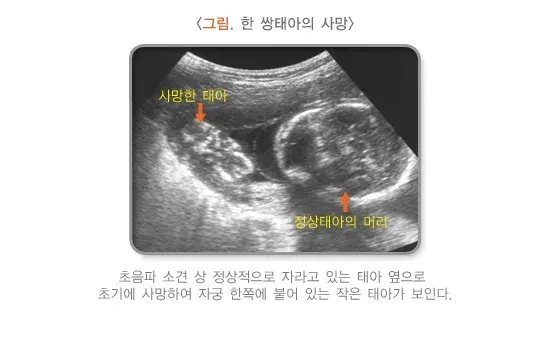 다태임신 합병증 설명 이미지 1