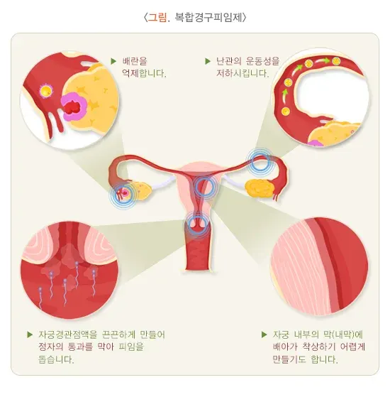 피임 치료 설명 이미지 1