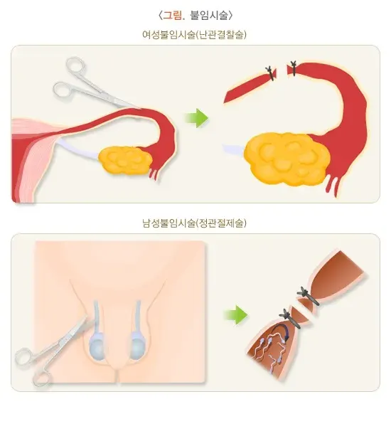 피임 비약물 치료 설명 이미지 4