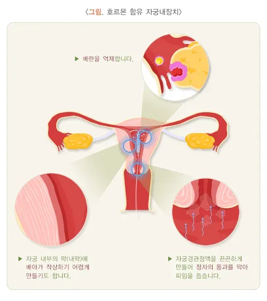 피임 치료 설명 이미지 4