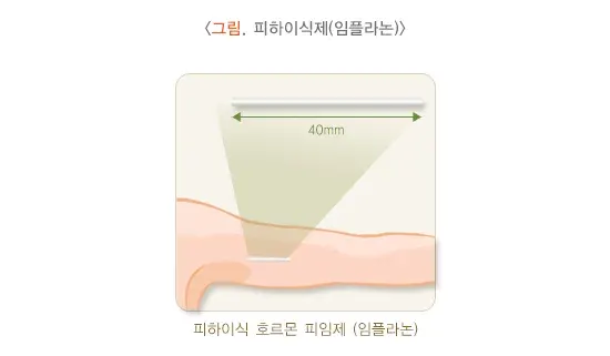 피임 치료 설명 이미지 5
