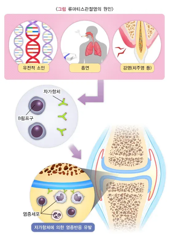류마티스관절염 원인 설명 이미지 1