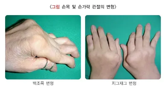 류마티스관절염 증상 설명 이미지 1