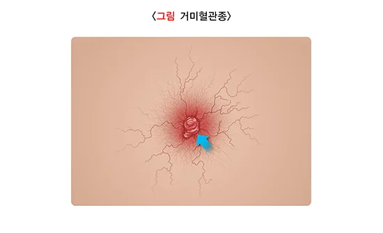 간경변증 증상 설명 이미지 1