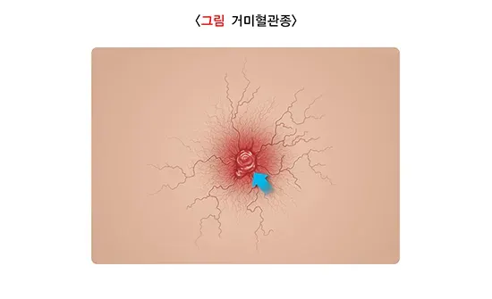 간경변증 증상 설명 이미지 1