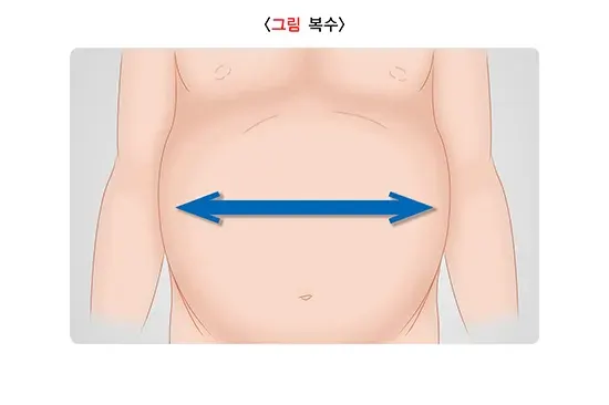 간경변증 증상 설명 이미지 3