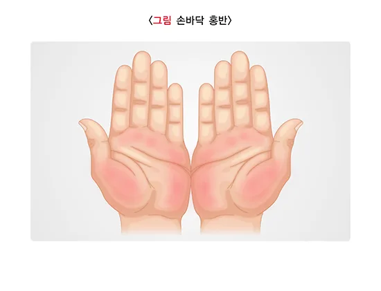 간경변증 증상 설명 이미지 2
