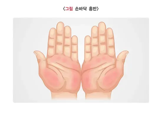 간경변증 증상 설명 이미지 2
