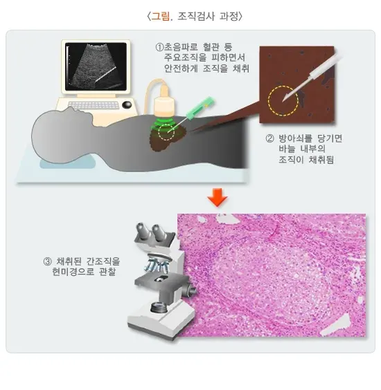 간경변증 진단 및 검사 설명 이미지 3