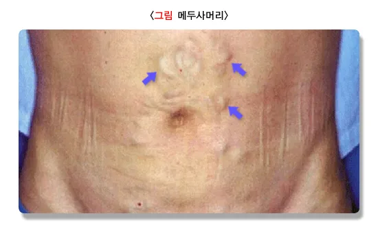 간경변증 진단 및 검사 설명 이미지 1