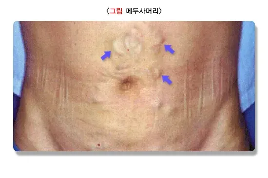 간경변증 진단 및 검사 설명 이미지 1